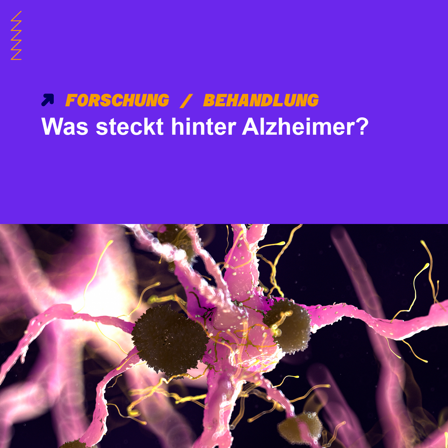 Alzheimer Pathophysiologie